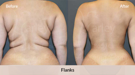 Abdomen & Flanks VASER Liposuction Sacramento