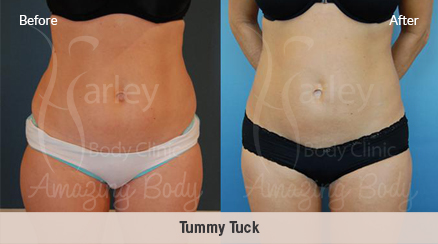 Tummy Tuck - Before & After Images - The Private Clinic of Harley Street  London